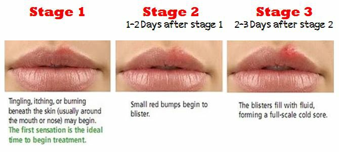 oral-herpes-stage