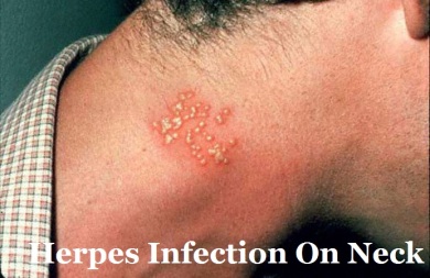 Herpes Infection On neck 1234